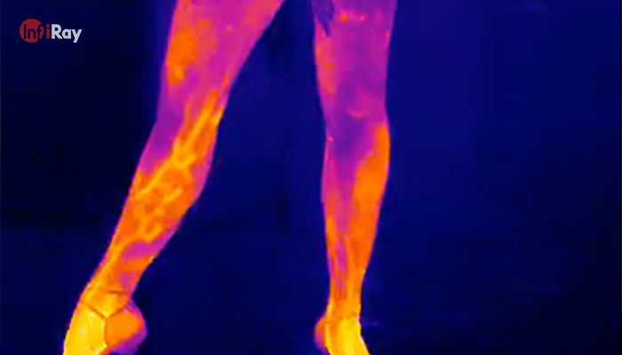 02InfiRay_thermal_imaging_employed_in_vascular_medicine_.png